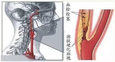 如何查腿动脉血栓?腿动脉血栓怎么检查