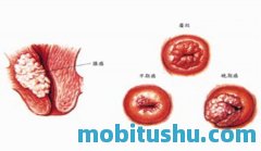 41周如何促进宫颈成熟?41周怎么让宫颈成熟